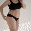 J-Plasma : La Technologie Révolutionnaire pour un Rajeunissement Cutané Sans Chirurgie